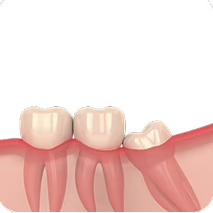 Wisdom  tooth extraction