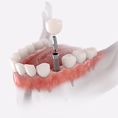 Implantation