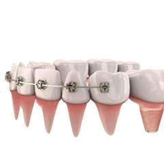 Braces