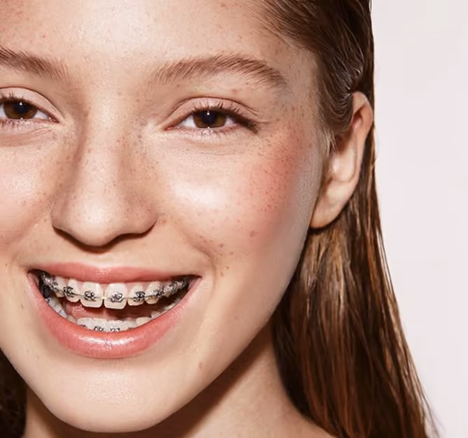 Close-up of a smiling young woman with braces and light freckles on her face.